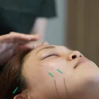 美容鍼