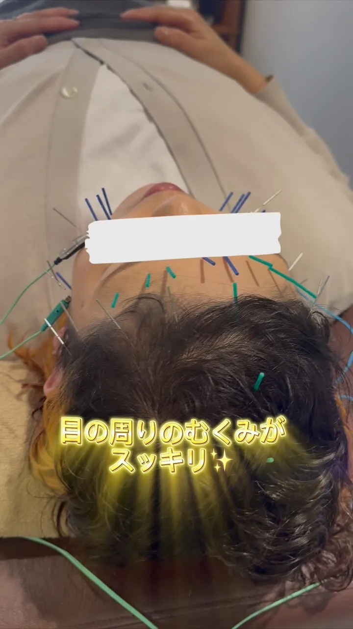 目の疲れがひどい方への美容鍼と頭の鍼