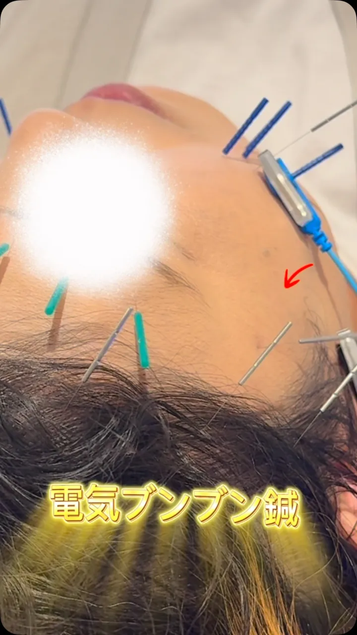 電気鍼って痛くないの〜？